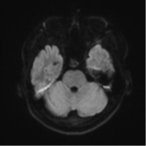 Acute left middle cerebral artery territory infarct with clot retrieval (Radiopaedia 47732-52433 Axial DWI 39).png