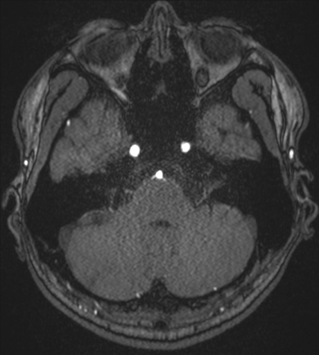 Acute left middle cerebral artery territory infarct with clot retrieval (Radiopaedia 47732-52433 Axial MRA 14).png