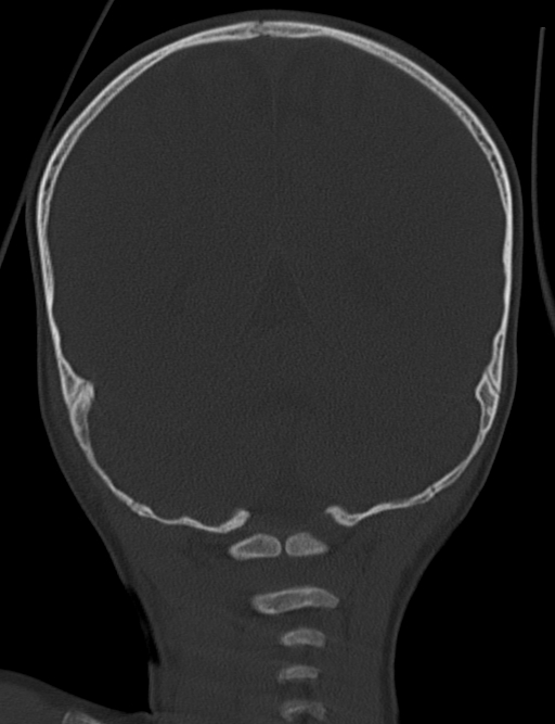Acute mastoiditis (Radiopaedia 82678-96881 Coronal bone window 57).jpg