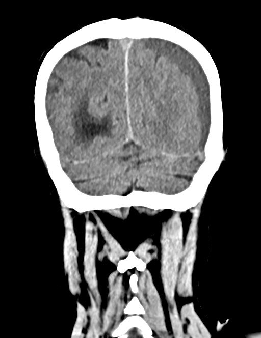 Acute on chronic subdural hematoma (Radiopaedia 74814-85823 Coronal non-contrast 53).jpg