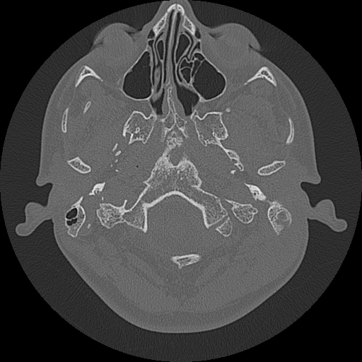 File:Acute otomastoiditis and Bezold abscess (Radiopaedia 88184-104786 Axial bone window 14).jpg