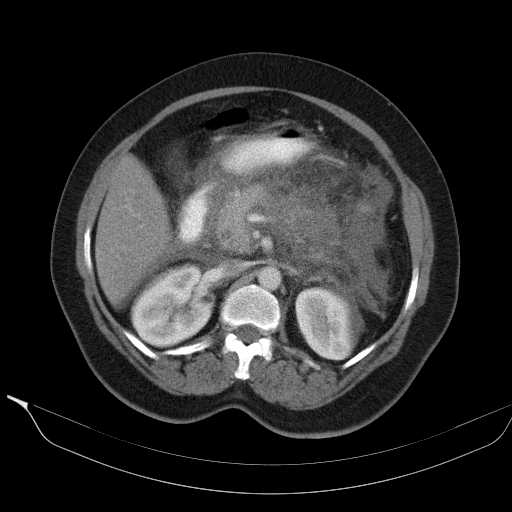 File:Acute pancreatitis (Radiopaedia 20829-20744 Axial C+ portal venous phase 18).jpg