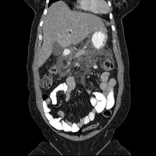 File:Acute pancreatitis (Radiopaedia 20829-20744 Coronal C+ portal venous phase 17).jpg