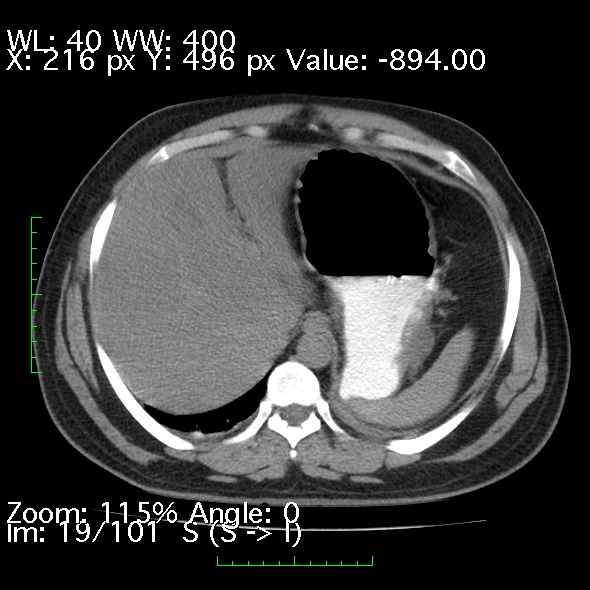 Acute pancreatitis (Radiopaedia 34043-35276 Axial non-contrast 19).jpg