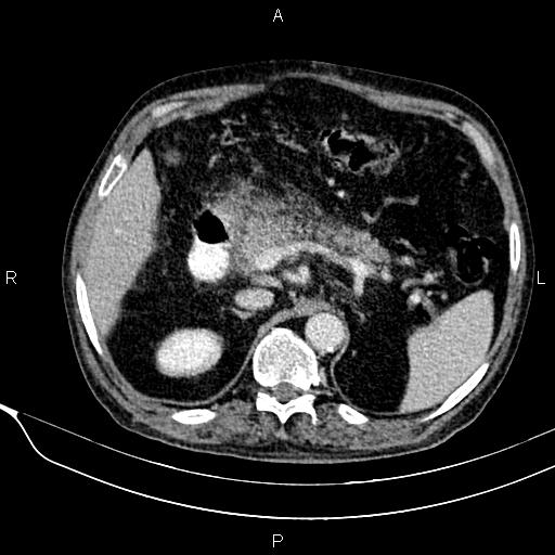Acute pancreatitis (Radiopaedia 85146-100701 Axial C+ portal venous phase 23).jpg