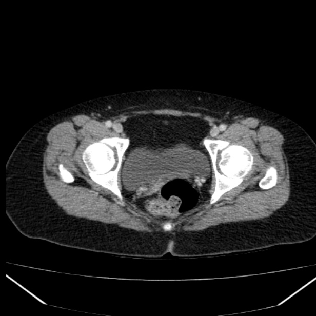Acute pancreatitis - Balthazar C (Radiopaedia 26569-26714 Axial C+ portal venous phase 90).jpg