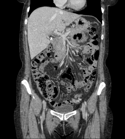 Acute pancreatitis - Balthazar E - post ERCP (Radiopaedia 27562-27772 Coronal C+ portal venous phase 31).png