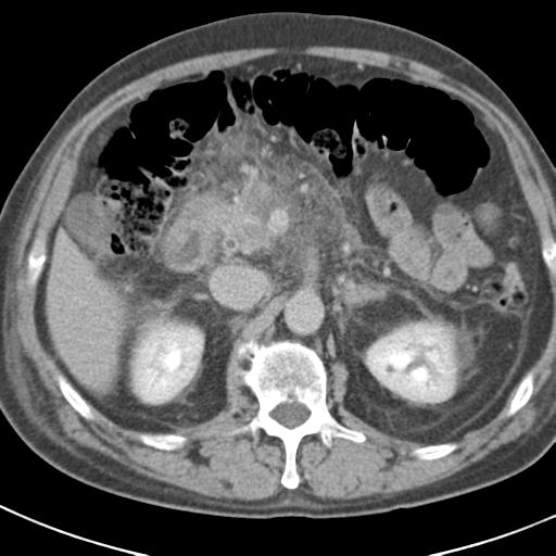 Acute pancreatitis and walled-off necrosis (Radiopaedia 29888-30403 Axial C+ delayed 31).jpg