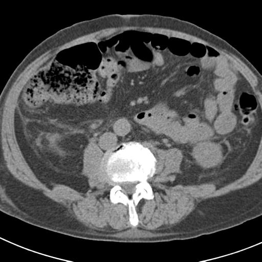 File:Acute pancreatitis and walled-off necrosis (Radiopaedia 29888-30403 Axial non-contrast 41).jpg