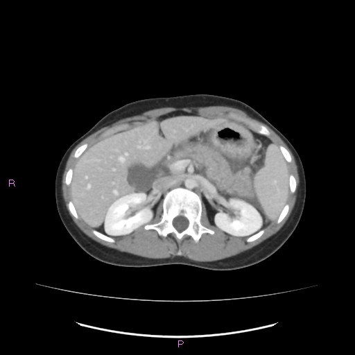 Acute pancreatitis secondary to stone at minor papilla and pancreatic divisum (Radiopaedia 76570-88333 Axial C+ portal venous phase 26).jpg