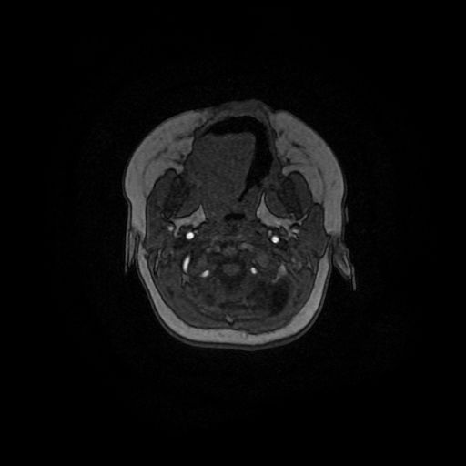 Acute phase of hemiconvulsion-hemiplegia epilepsy syndrome (Radiopaedia 29309-29745 Axial TOF angiography 160).jpg