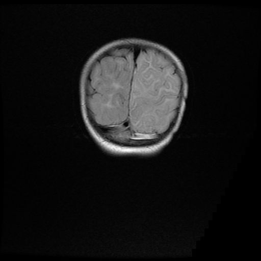 File:Acute phase of hemiconvulsion-hemiplegia epilepsy syndrome (Radiopaedia 29309-29745 Coronal FLAIR 21).jpg