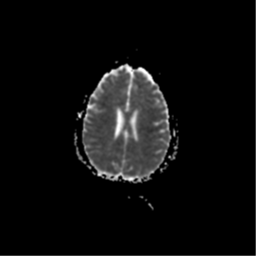 File:Acute pontine infarct from vertebral artery dissection (Radiopaedia 34111-35370 Axial ADC 15).png