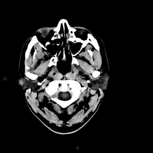 Acute posterior cerebral artery territory infarct (Radiopaedia 79329-92393 Axial non-contrast 5).jpg