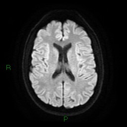 Acute posterior cerebral artery territory infarct (Radiopaedia 79329-92394 Axial DWI 17).jpg