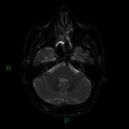 Acute posterior cerebral artery territory infarct (Radiopaedia 79329-92394 Axial DWI 36).jpg