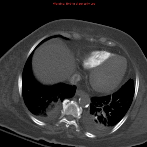 File:Acute pulmonary embolism (Radiopaedia 13286-13289 Axial C+ CTPA 50).jpg