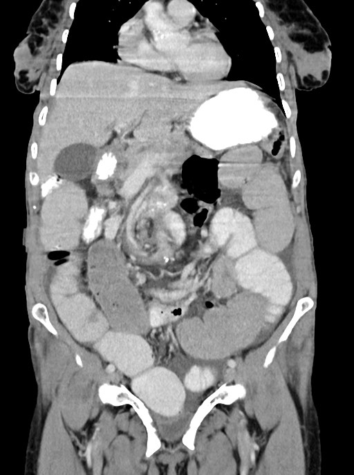 Acute small bowel (ileal) volvulus (Radiopaedia 71740-82139 Coronal C+ portal venous phase 46).jpg