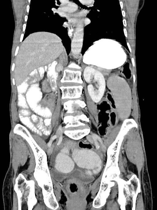 Acute small bowel (ileal) volvulus (Radiopaedia 71740-82139 Coronal C+ portal venous phase 69).jpg