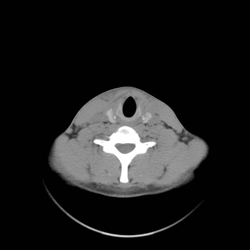 File:Acute submandibular sialadenitis secondary to ductal stone (Radiopaedia 27999-28267 Axial non-contrast 26).jpg