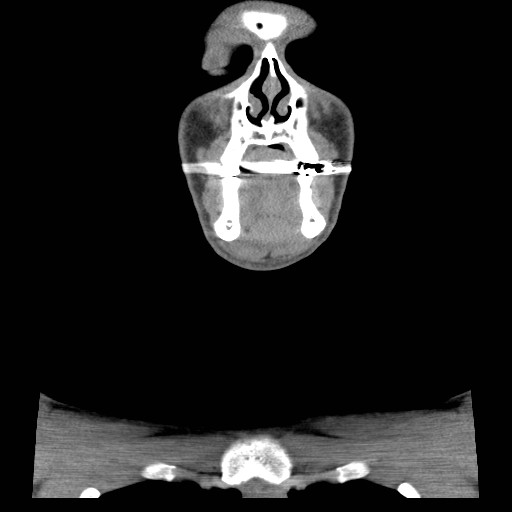 File:Acute submandibular sialadenitis secondary to ductal stone (Radiopaedia 27999-28267 Coronal C+ delayed 13).jpg