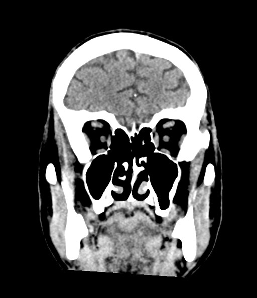 Acute superior cerebellar artery territory infarct (Radiopaedia 84104-99359 Coronal non-contrast 31).jpg