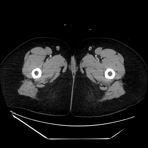 File:Acute uncomplicated appendicitis (Radiopaedia 73704-84499 Axial C+ portal venous phase 188).jpg