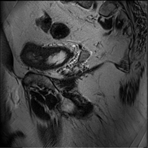 File:Adenocarcioma of rectum- T1 lesion (Radiopaedia 36921-38546 Sagittal T2 18).png