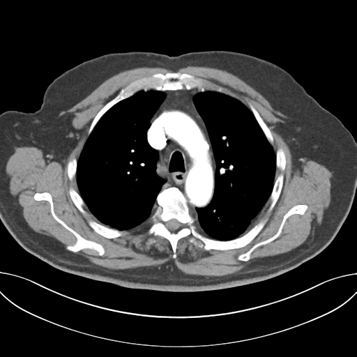 Adenocarcioma of rectum- T1 lesion (Radiopaedia 36921-38547 Axial C+ arterial phase 20).png