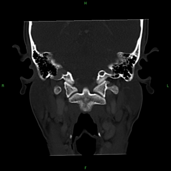 File:Adenoid cystic carcinoma of hard palate (Radiopaedia 26137-26273 Coronal bone window 26).jpg