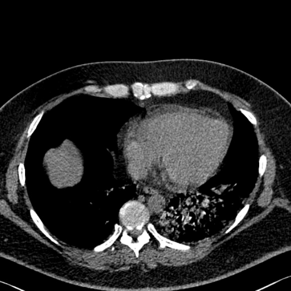 Adenoid cystic carcinoma of the trachea (Radiopaedia 49042-54137 Axial non-contrast 246).jpg