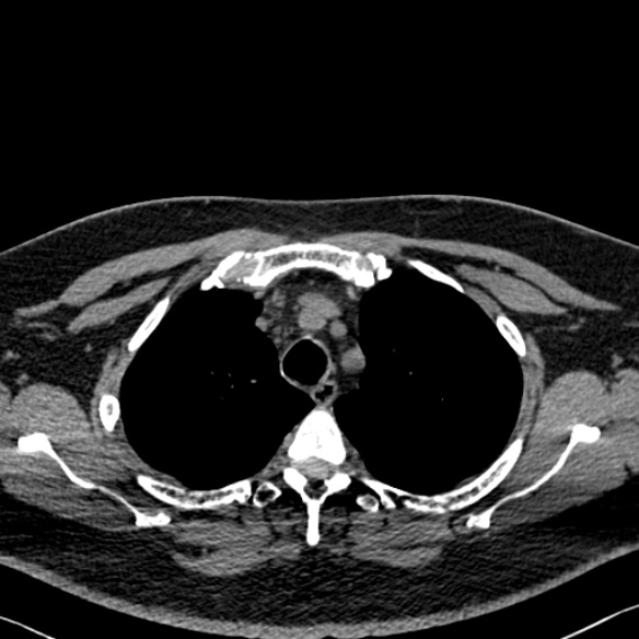 Adenoid cystic carcinoma of the trachea (Radiopaedia 49042-54137 Axial non-contrast 76).jpg