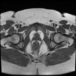 File:Adenomyosis within a didelphys uterus (Radiopaedia 70175-80215 Axial T1 35).jpg