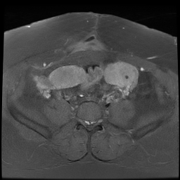 File:Adenomyosis within a didelphys uterus (Radiopaedia 70175-80215 Axial T1 C+ fat sat 15).jpg