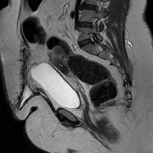 File:Adenomyosis within a didelphys uterus (Radiopaedia 70175-80215 Sagittal T2 16).jpg
