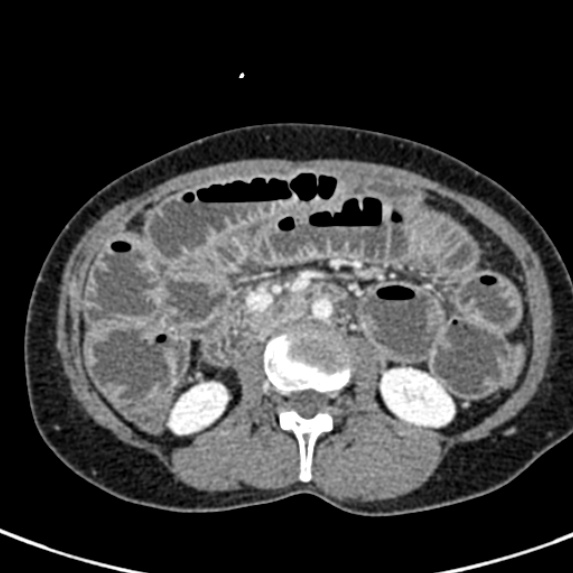Adhesional small bowel obstruction (Radiopaedia 48397-53305 Axial C+ portal venous phase 37).jpg