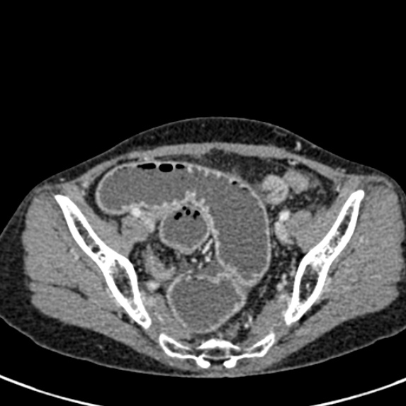 Adhesional small bowel obstruction (Radiopaedia 48397-53305 Axial C+ portal venous phase 75).jpg
