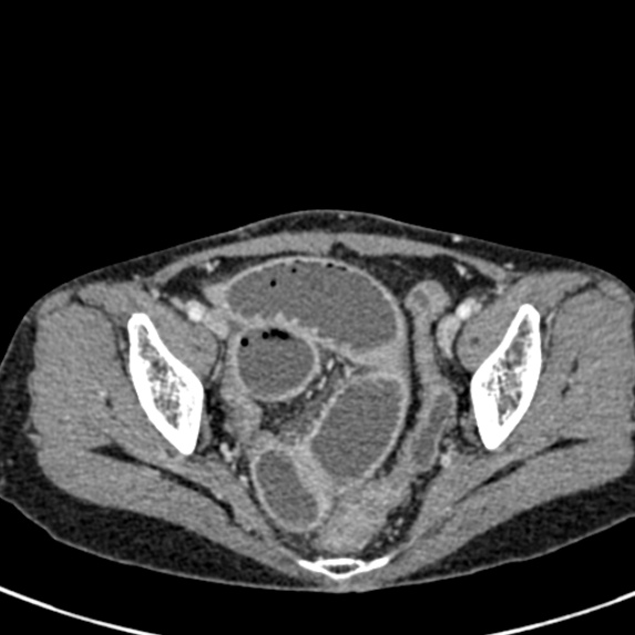 Adhesional small bowel obstruction (Radiopaedia 48397-53305 Axial C+ portal venous phase 80).jpg