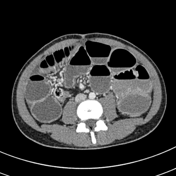 File:Adhesional small bowel obstruction (Radiopaedia 52107-57980 Axial C+ portal venous phase 69).jpg