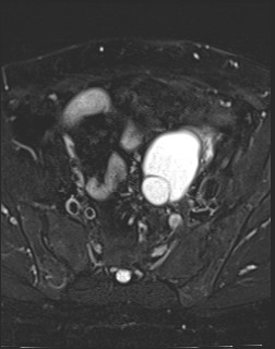 File:Adnexal multilocular cyst (O-RADS US 3- O-RADS MRI 3) (Radiopaedia 87426-103754 Axial T2 fat sat 7).jpg