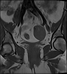 File:Adnexal multilocular cyst (O-RADS US 3- O-RADS MRI 3) (Radiopaedia 87426-103754 Coronal 17).jpg