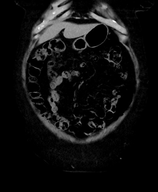 Adrenal cortical carcinoma (Radiopaedia 64017-72769 Coronal C+ delayed 15).jpg