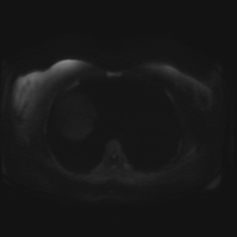 Adrenal cortical carcinoma (Radiopaedia 70906-81116 Axial DWI 29).jpg