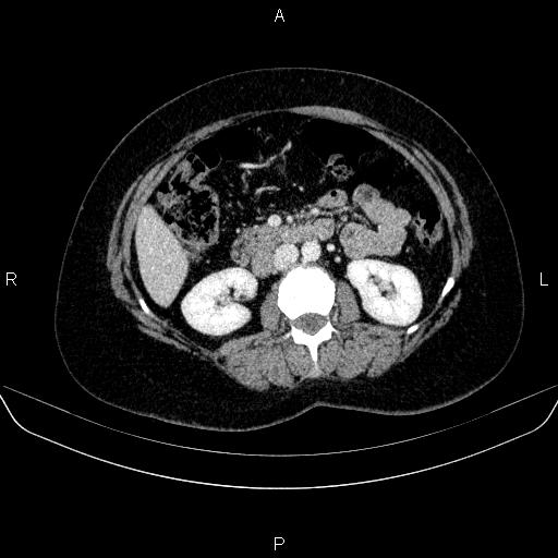Adrenal cortical carcinoma (Radiopaedia 84882-100379 Axial C+ portal venous phase 40).jpg