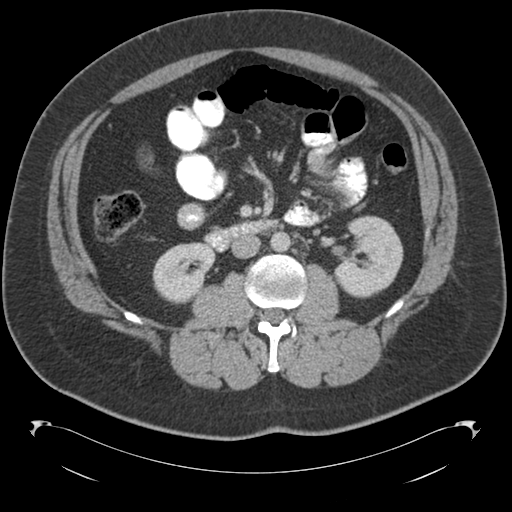 Adrenal cyst (Radiopaedia 45625-49776 Axial C+ portal venous phase 46).png