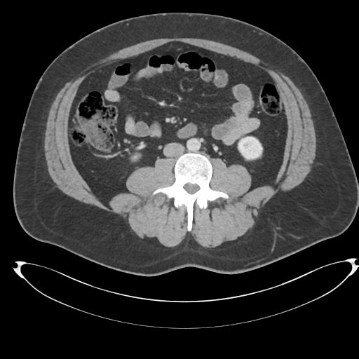 File:Adrenal cyst (Radiopaedia 45625-49778 AXIAL THICK 60 sec 60).png