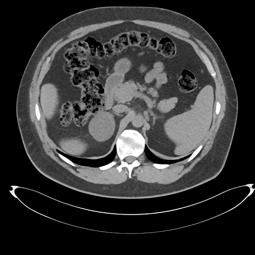 File:Adrenal cyst (Radiopaedia 45625-49778 Axial non-contrast 33).png