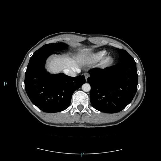 Adrenal cystic lymphangioma (Radiopaedia 83161-97534 Axial C+ portal venous phase 11).jpg