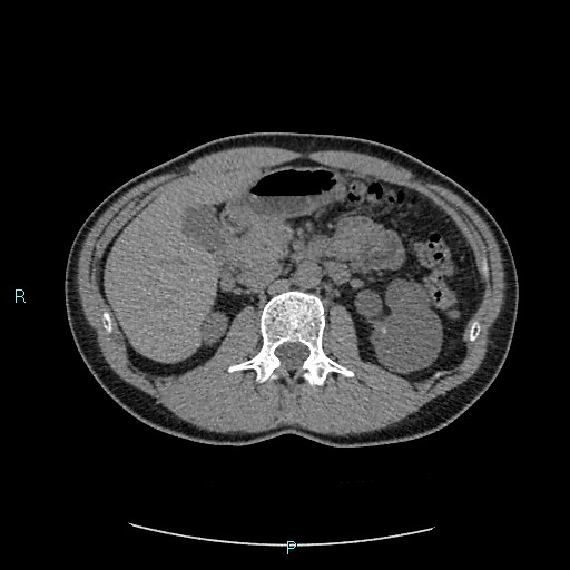 File:Adrenal cystic lymphangioma (Radiopaedia 83161-97534 Axial non-contrast 36).jpg