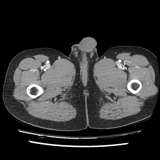 Adrenal gland trauma (Radiopaedia 81351-95078 Axial Dual bolus trauma C+ 132).jpg